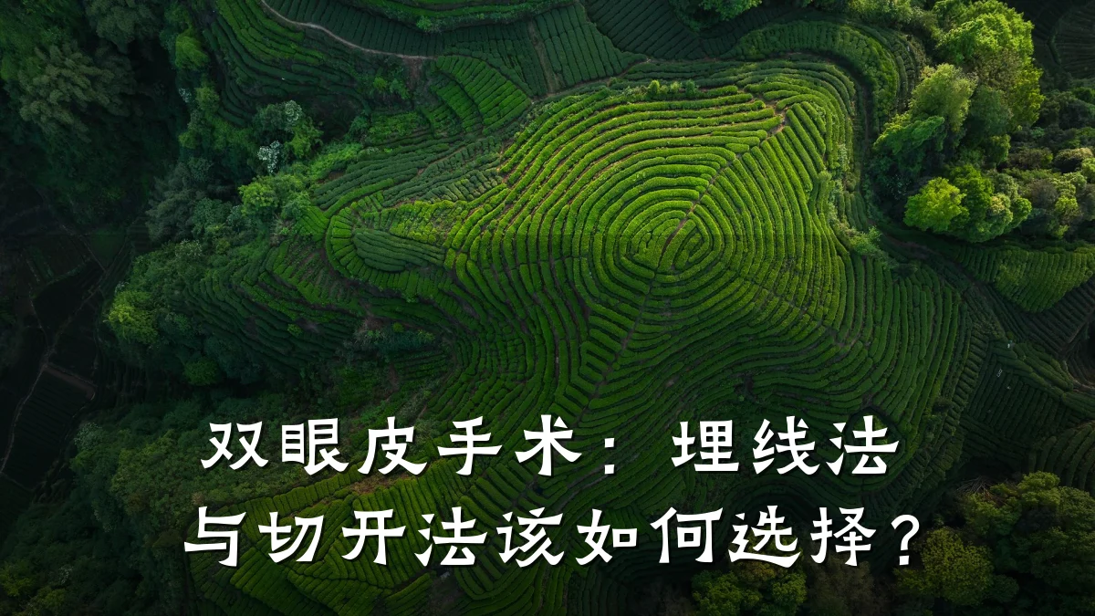双眼皮手术:埋线法与切开法该如何选择?